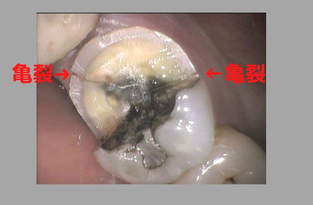 歯が縦に割れている歯根破折｜高松市の歯を削らない治療なら吉本歯科医院
